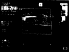 ֫�嶯��˨����Ѫ˨�γ���˨��Ч����(9���ٴ�����)