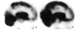 <sup>123</sup>I-Iomazenil SPECTλļֵ