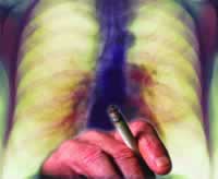 25%߽COPD