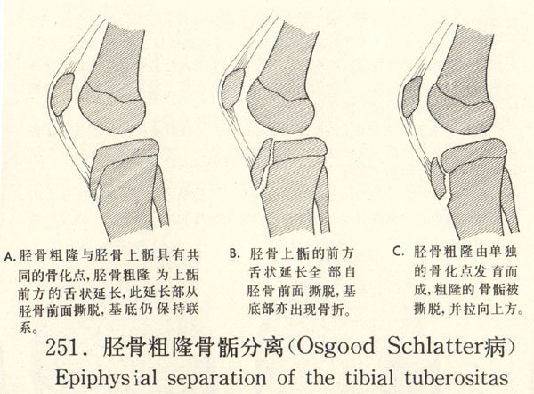 ֹǴ¡(Osgood Schlatter)