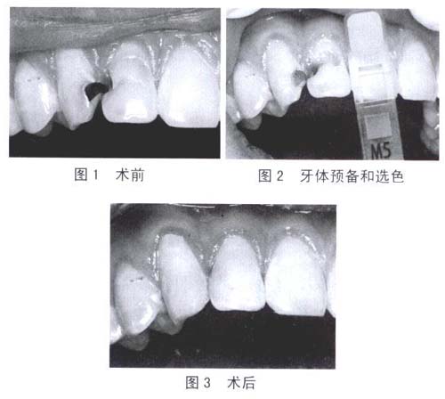 ֬ceram-Xǰȣ޸еӦ