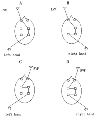 Is Happy Faciak Expression Identified by the Left or Right Hemisphere